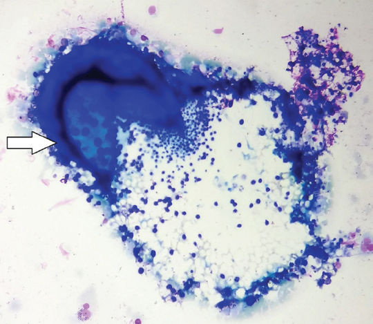 Cytology smear showing ruptured mature sporangia liberating endospores (Giemsa stain, ×40).